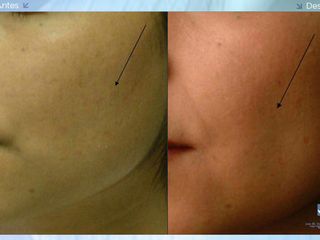 Antes y despues de bichectomia