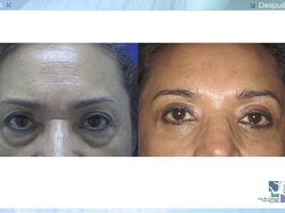 Antes y despues de blefaroplastia