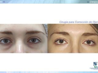 Antes y despues de blefaroplastia