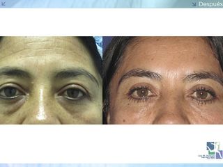 Antes y despues de blefaroplastia