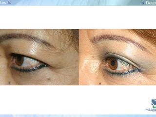 Antes y despues de blefaroplastia