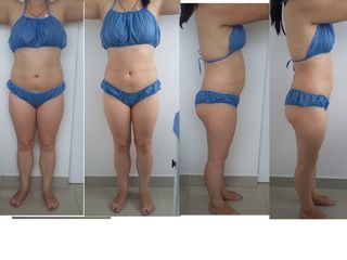 Hidrolipoclasia
