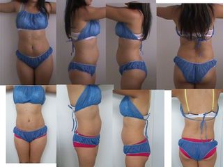 hidrolipoclasia. antes en las de arriba y dos meses despues abajo
