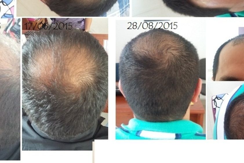 Alopecia antes y después - 569027