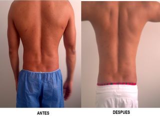Hidrolipoclasia en hombre 