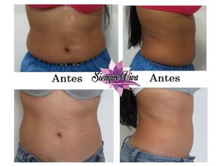 Disminución de medidas con Hidrolipoclasia