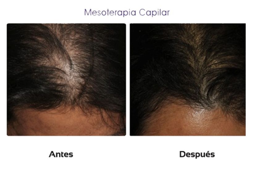 Trasplantes capilares antes y después - 510437