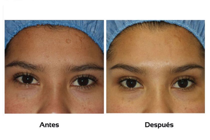 Cicatrices antes y después - 510438