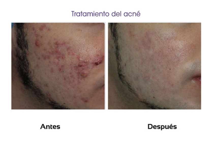 Acné antes y después - 510441