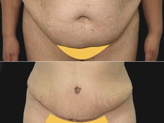Abdominoplastia antes y después - 875506