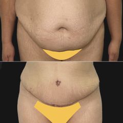 Abdominoplastia - Dra. Damaris Romero