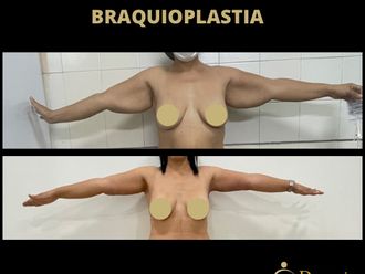 Cirugía reconstructiva antes y después - 880268
