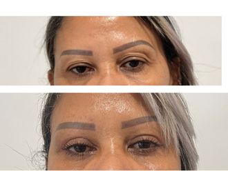 Blefaroplastia antes y después - 880269