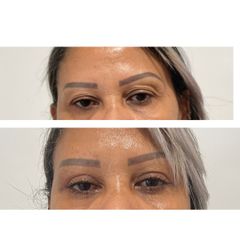 BLEFAROPLASTIA SUPERIOR