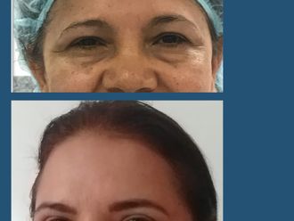 Blefaroplastia antes y después - 880270