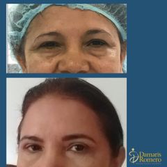 BLEFAROPLASTIA SUPERIOR E INFERIOR