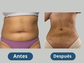 Lipoescultura antes y después - 880271