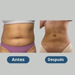 lipoescultura