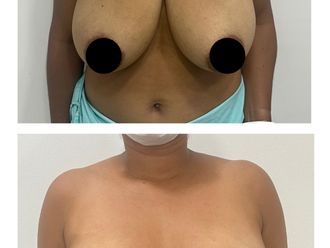Mamoplastia de reducción antes y después - 880273