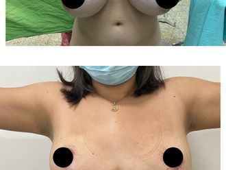 Mamoplastia de reducción antes y después - 880274