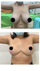 MAMOPLASTIA DE REDUCCION