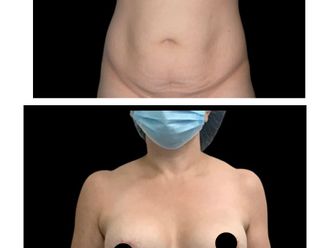 Mamoplastia de aumento antes y después - 880279