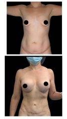 Mamas aumento y LipoAbdominoplastica  - Dra. Damaris Romero