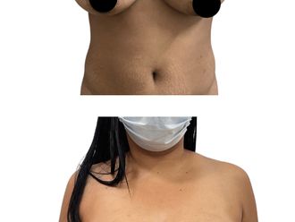 Mamoplastia de reducción antes y después - 880281