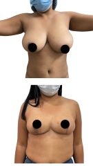 Mamoplastia de Reducción -Dra. Damaris Romero