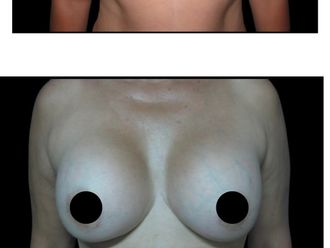 Mamoplastia de aumento antes y después - 880282