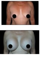 Mamoplastia de Aumento -Dra. Damaris Romero