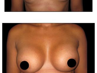 Mamoplastia de aumento antes y después - 880283