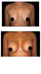 Mamoplastia de Aumento -Dra. Damaris Romero