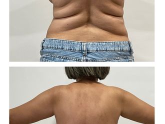 Lipoescultura antes y después - 880284