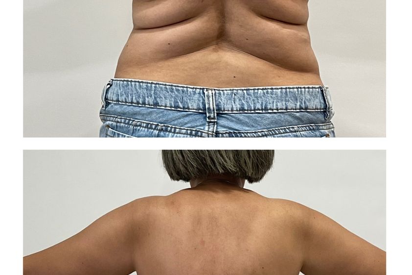 Lipoescultura antes y después - 880284