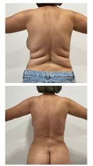 Lipo Ultrasonica Técnica VASER - Dra. Damaris Romero