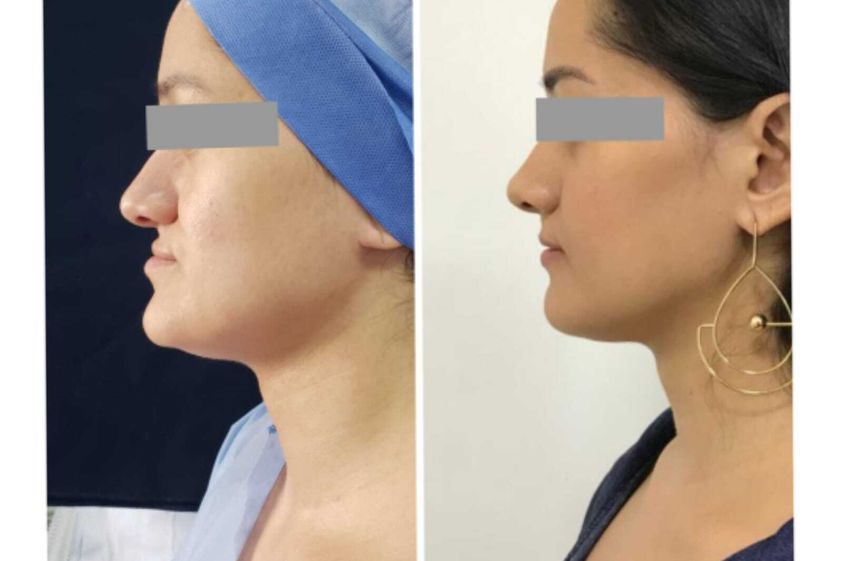 Cirugía maxilofacial antes y después - 800748