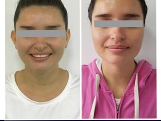 Otoplastia - 800749