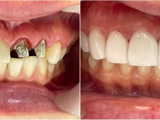 Implantes dentales - 816458