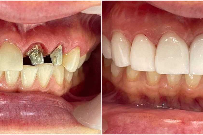 Implantes dentales antes y después - 816458