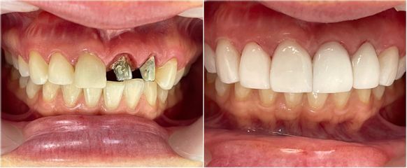 Implantes dentales - Dr. Andrés Felipe Revelo Salamanca