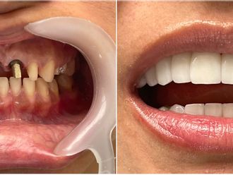 Implantes dentales - 816459