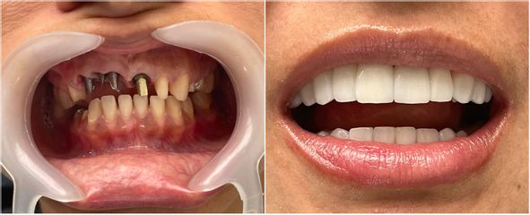 Implantes dentales - Dr. Andrés Felipe Revelo Salamanca