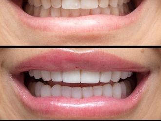 Blanqueamiento dental - 844892