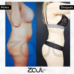 Liposucción - Dra. Carolina Hoyos Rave