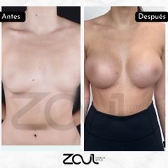 Mamoplastia de aumento - Dra. Carolina Hoyos Rave