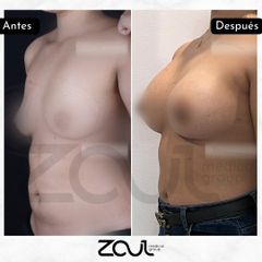 Mamoplastia de aumento - Dra. Carolina Hoyos Rave