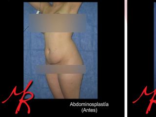 LIPOSUCCION Y ABDOMINOPLASTICA