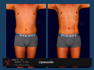 LIPOSUCCION Y MARCACION ABDOMINAL