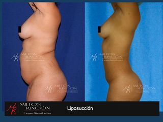 LIPOSUCCION